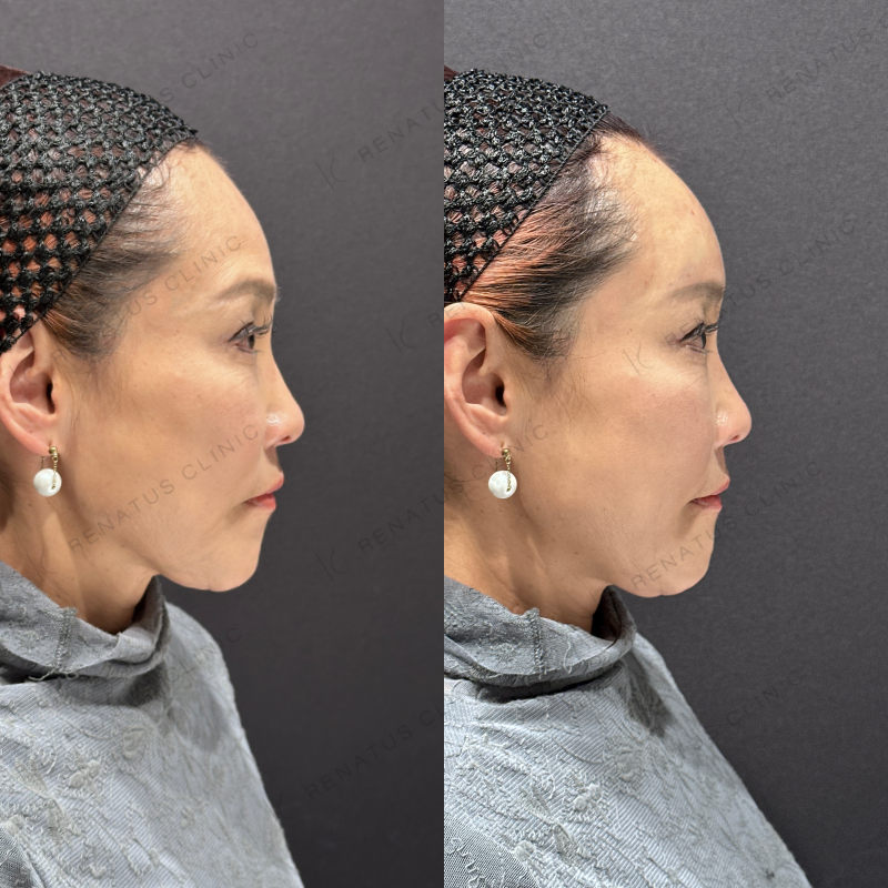 額ヒアルロン酸ボリューマ症例写真