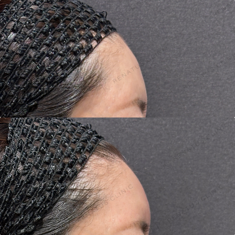 額ヒアルロン酸ボリューマ症例写真