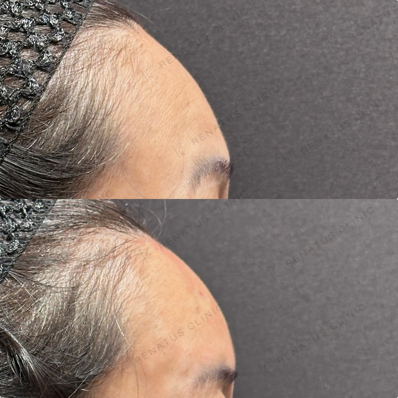 額ヒアルロン酸ボリューマ症例写真