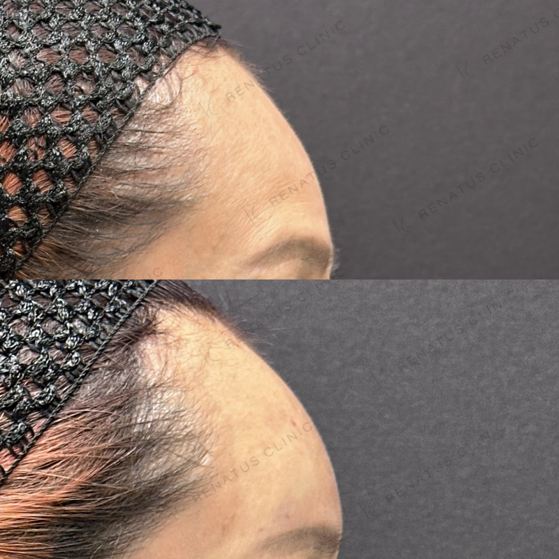 額ヒアルロン酸ボリューマ症例写真