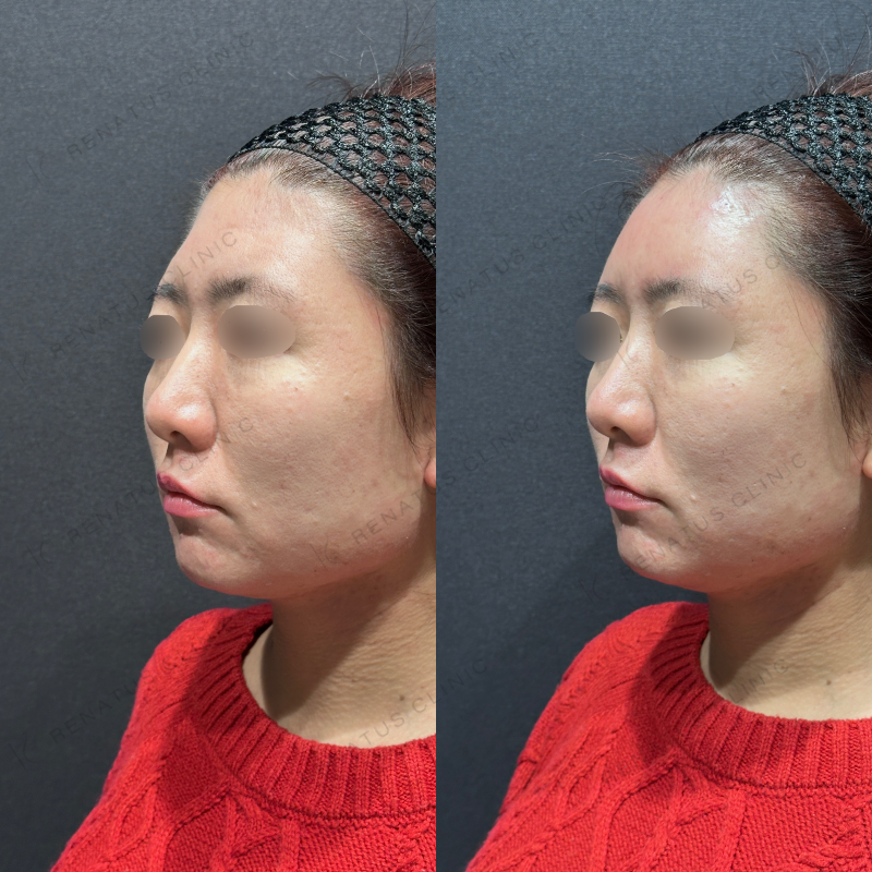 額ヒアルロン酸ボリューマ症例写真