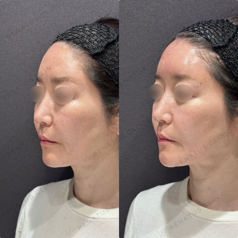 額ヒアルロン酸ボリューマ症例写真