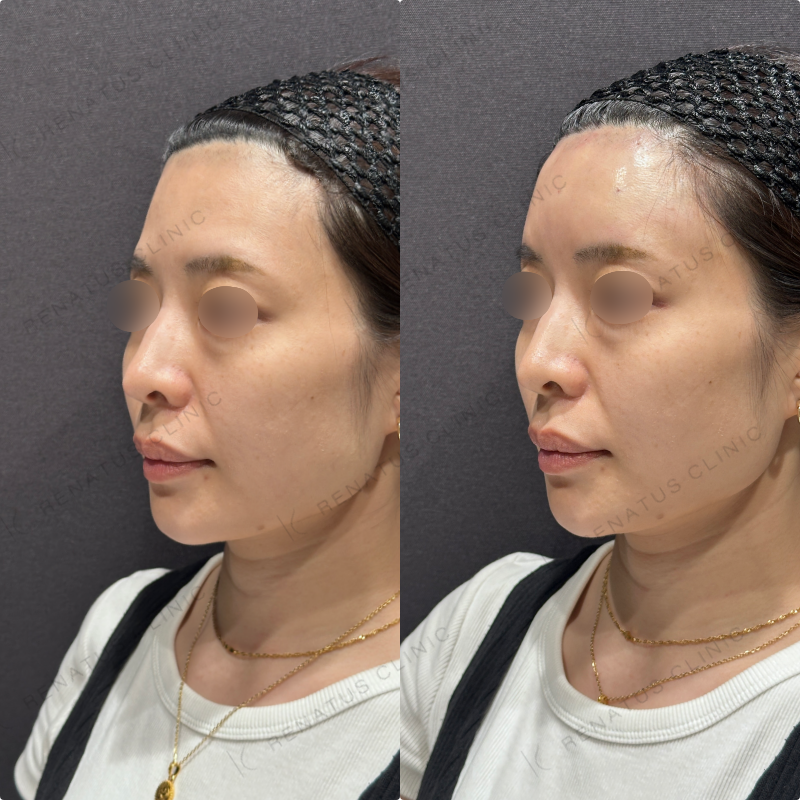 額ヒアルロン酸ボリューマ症例写真