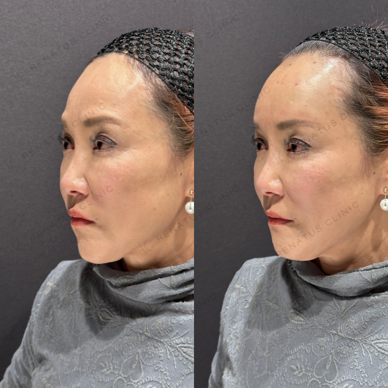 額ヒアルロン酸ボリューマ症例写真