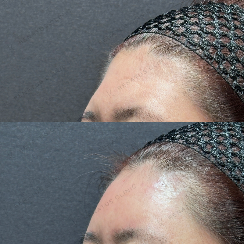 額ヒアルロン酸ボリューマ症例写真