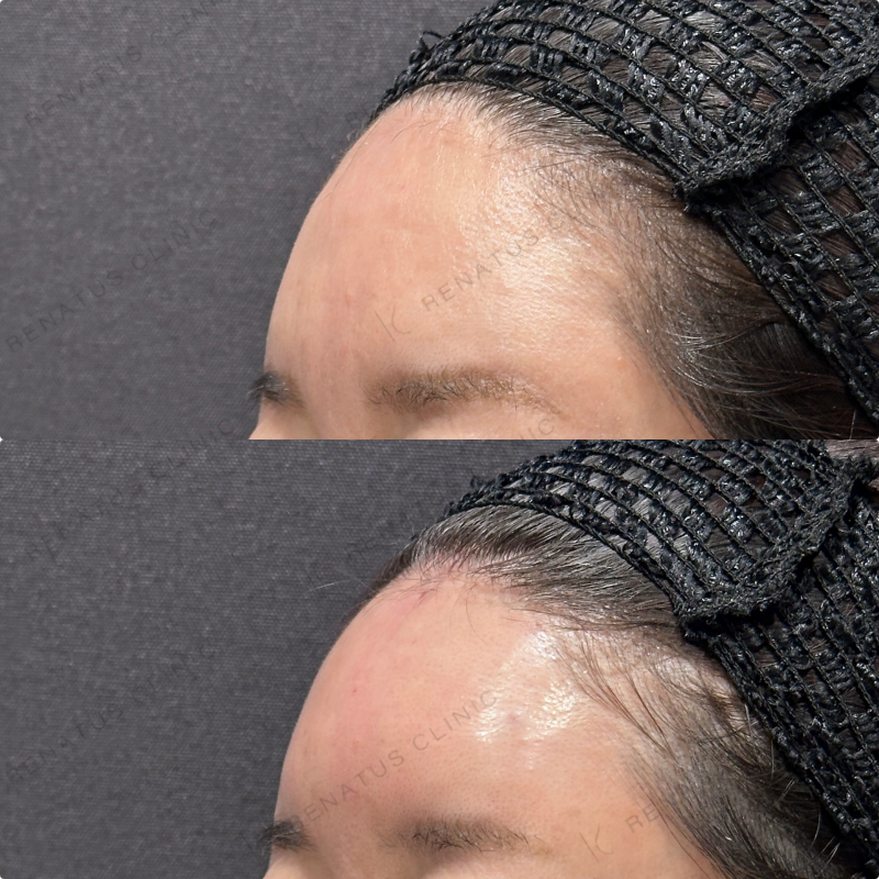 額ヒアルロン酸ボリューマ症例写真