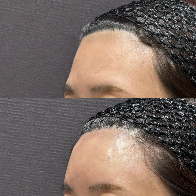 額ヒアルロン酸ボリューマ症例写真