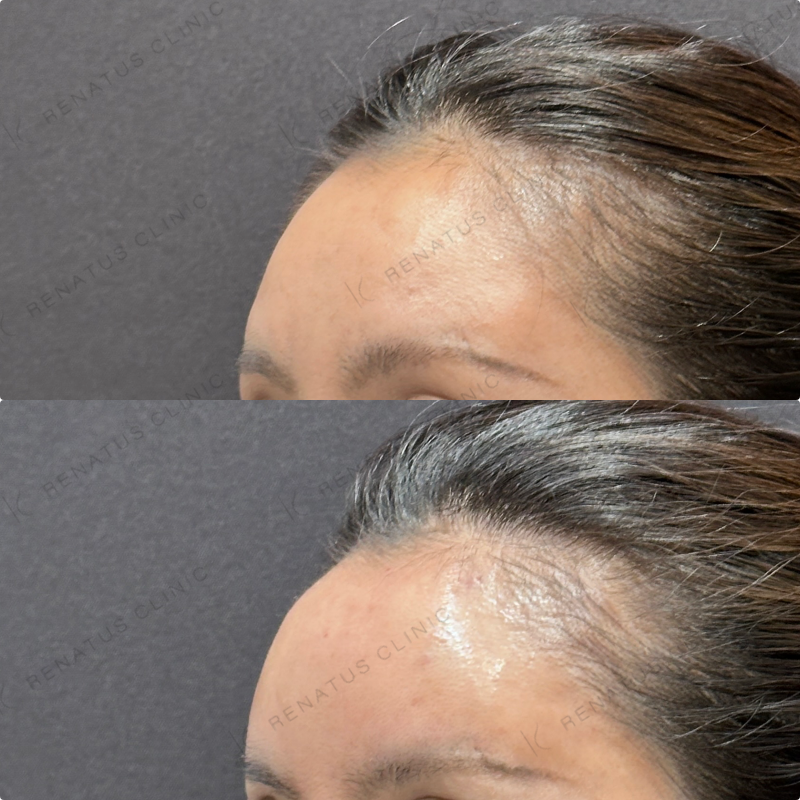 額ヒアルロン酸ボリューマ症例写真