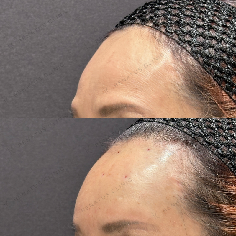 額ヒアルロン酸ボリューマ症例写真