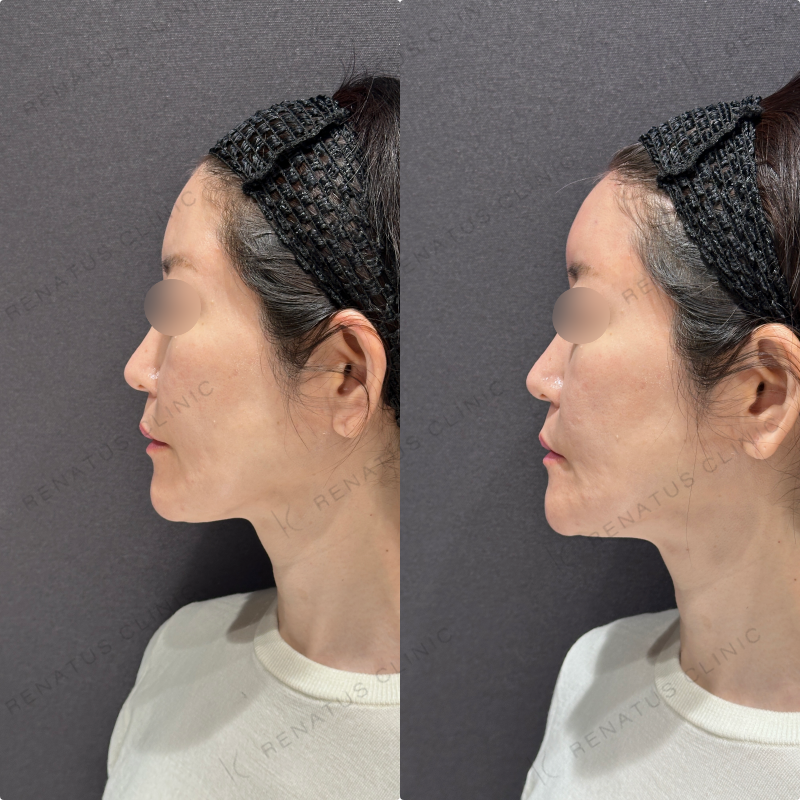 額ヒアルロン酸ボリューマ症例写真