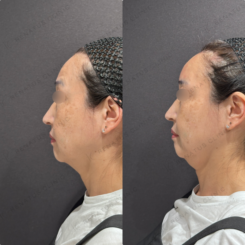 額ヒアルロン酸ボリューマ症例写真