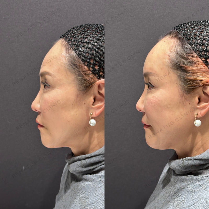 額ヒアルロン酸ボリューマ症例写真