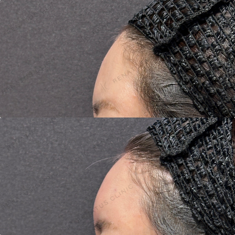 額ヒアルロン酸ボリューマ症例写真