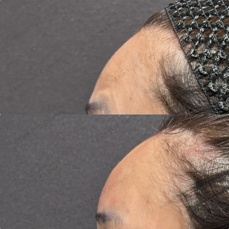 額ヒアルロン酸ボリューマ症例写真