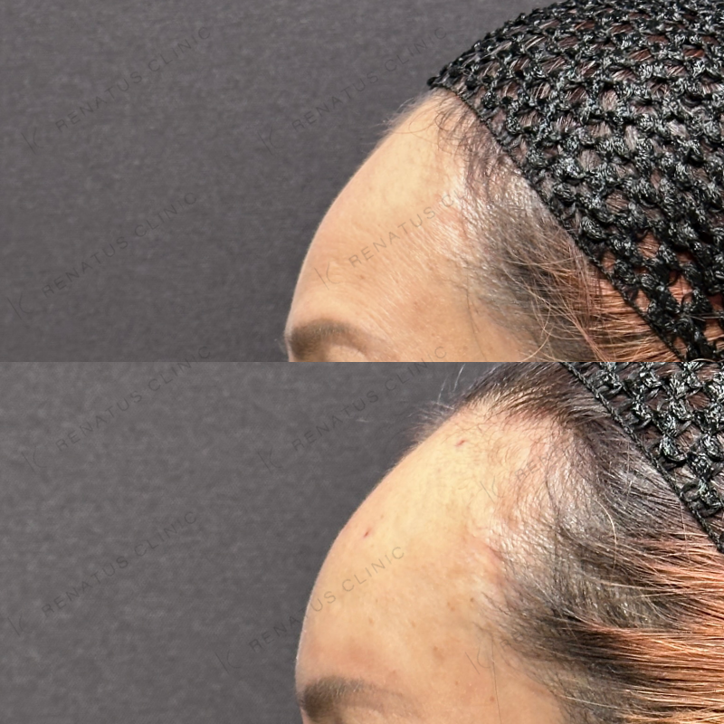 額ヒアルロン酸ボリューマ症例写真