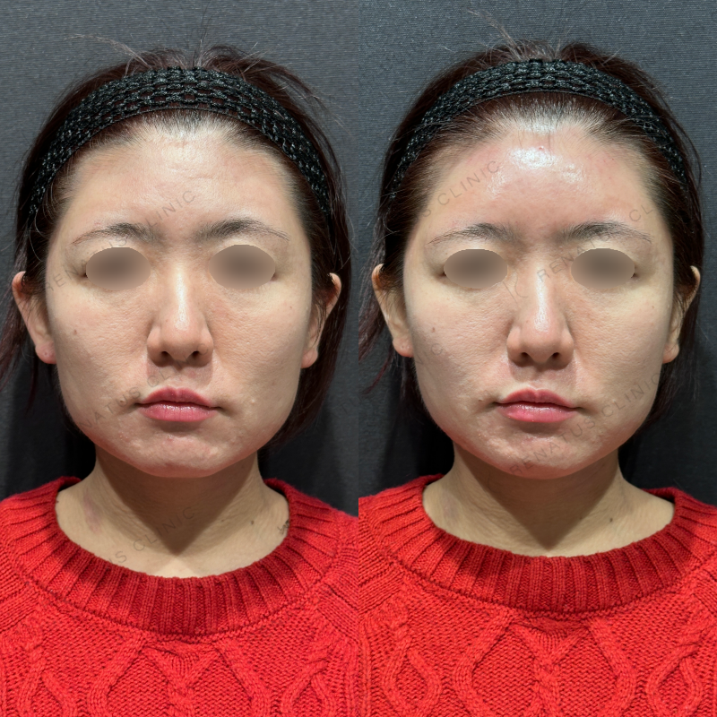 額ヒアルロン酸ボリューマ症例写真