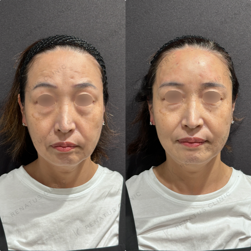 額ヒアルロン酸ボリューマ症例写真