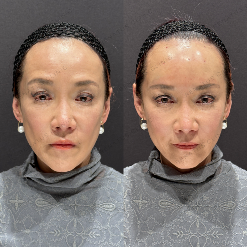 額ヒアルロン酸ボリューマ症例写真