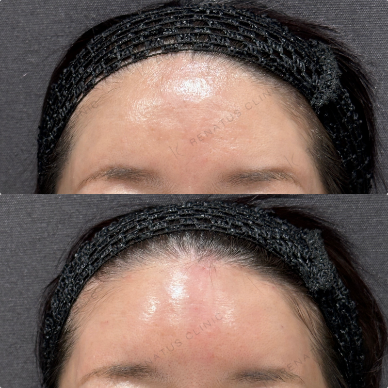 額ヒアルロン酸ボリューマ症例写真