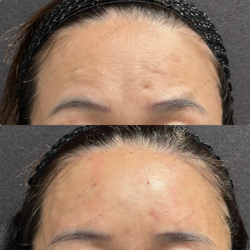 額ヒアルロン酸ボリューマ症例写真