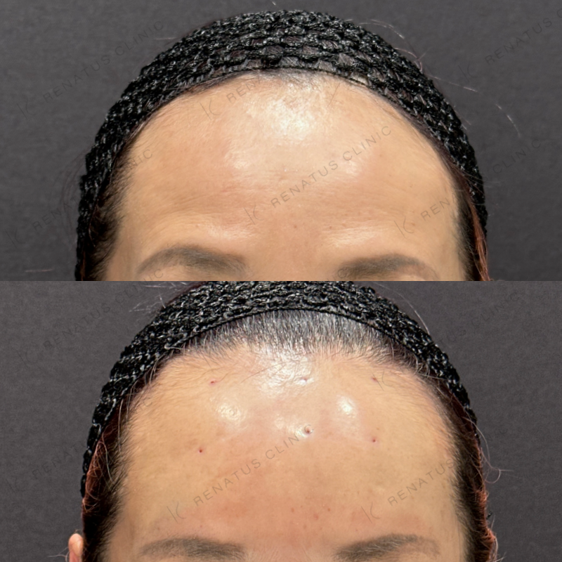 額ヒアルロン酸ボリューマ症例写真