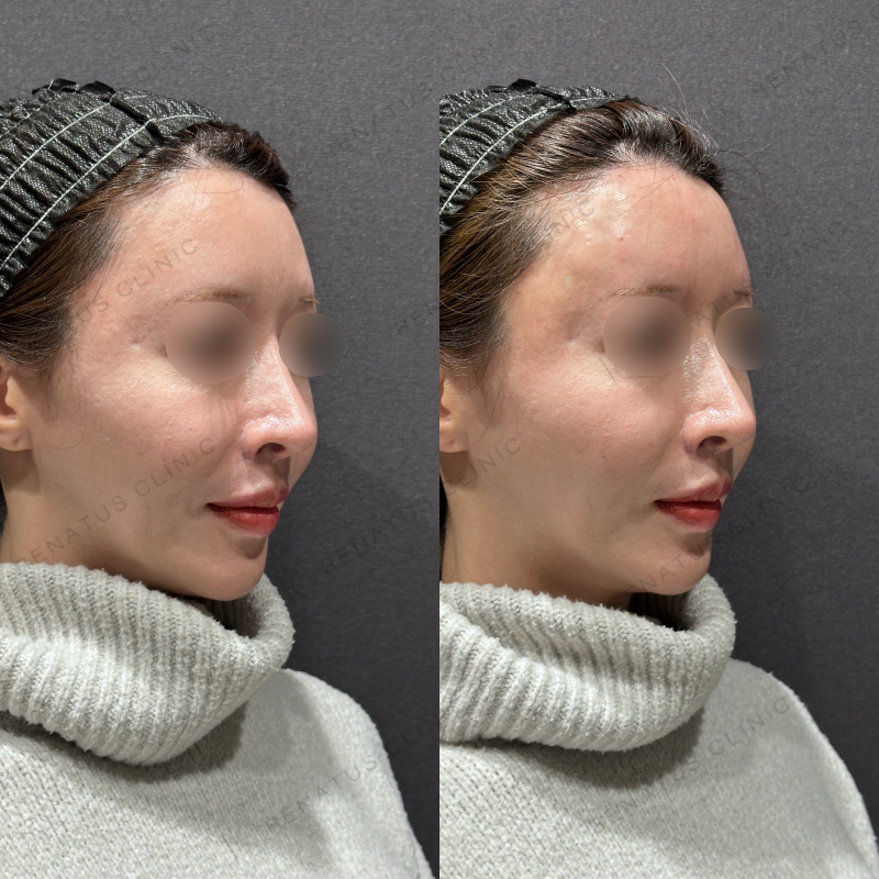 額・こめかみヒアルロン酸ボリューマ症例写真