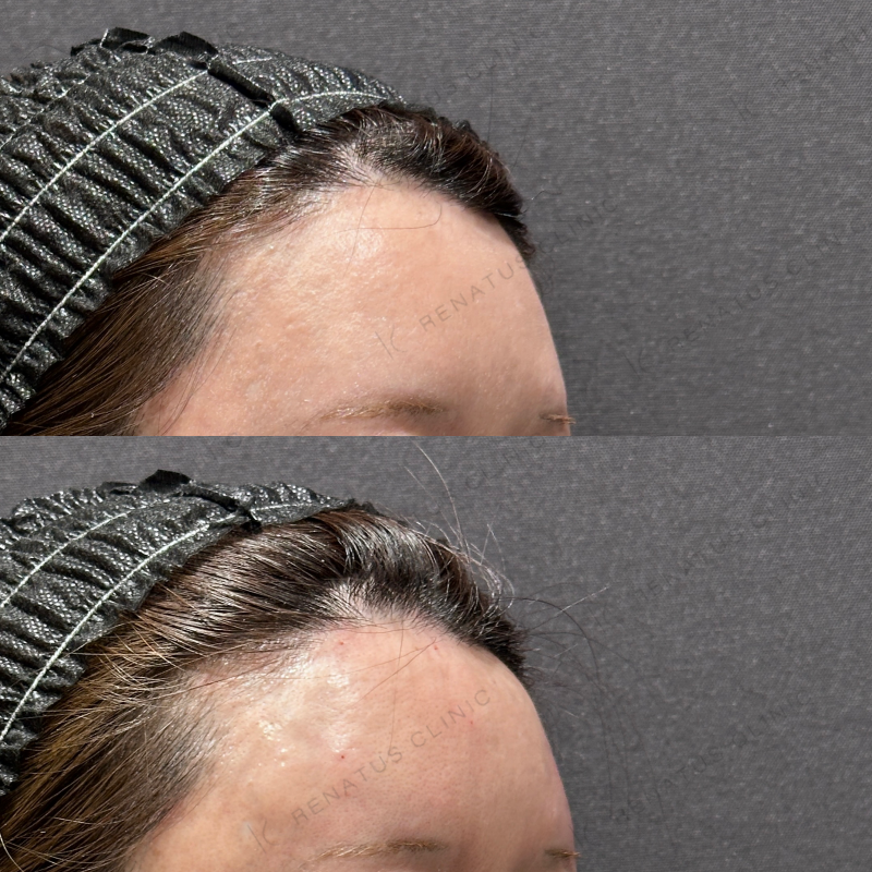 額・こめかみヒアルロン酸ボリューマ症例写真