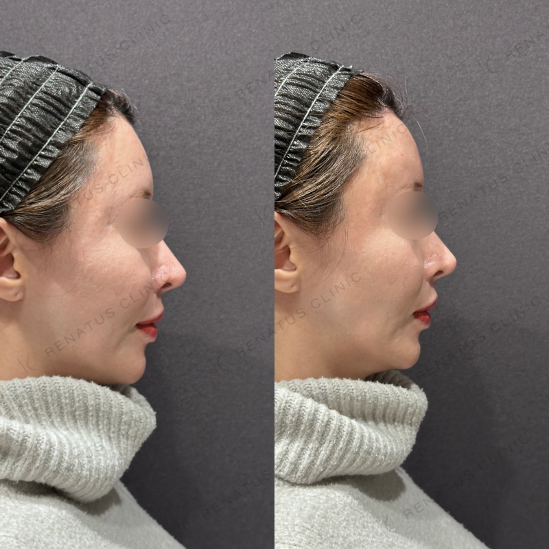 額・こめかみヒアルロン酸ボリューマ症例写真