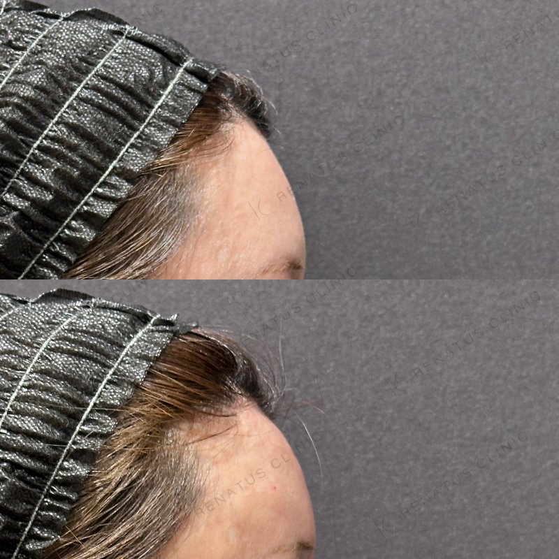 額・こめかみヒアルロン酸ボリューマ症例写真