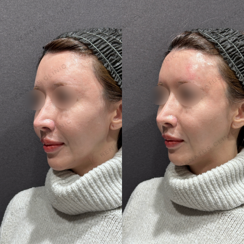 額・こめかみヒアルロン酸ボリューマ症例写真