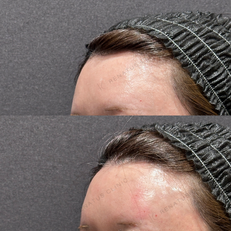 額・こめかみヒアルロン酸ボリューマ症例写真