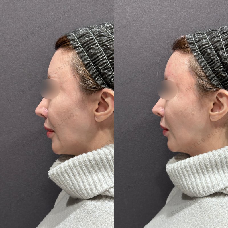 額・こめかみヒアルロン酸ボリューマ症例写真