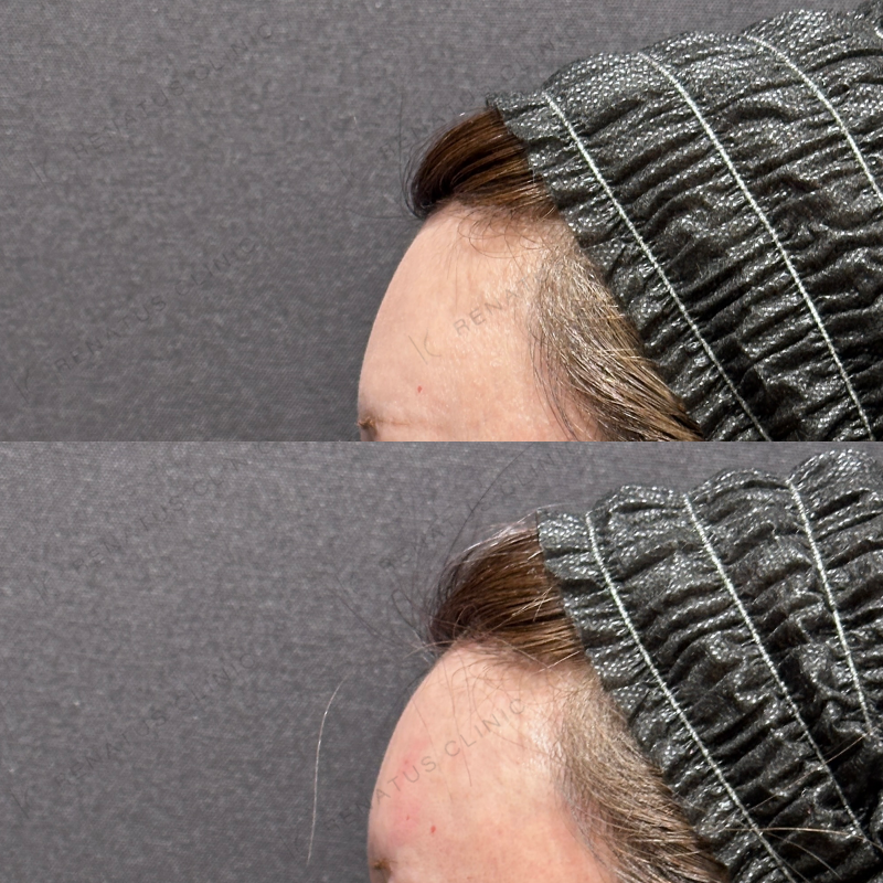 額・こめかみヒアルロン酸ボリューマ症例写真