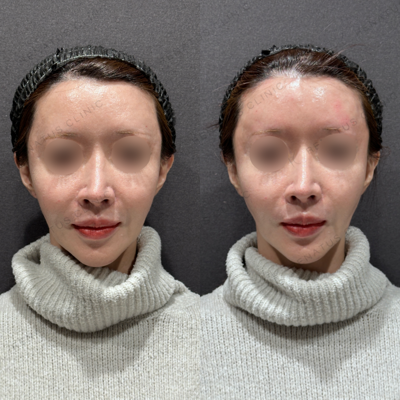 額・こめかみヒアルロン酸ボリューマ症例写真