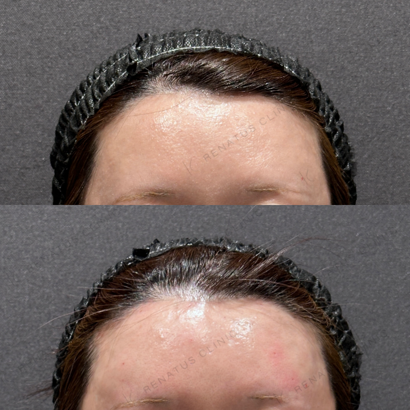 額・こめかみヒアルロン酸ボリューマ症例写真