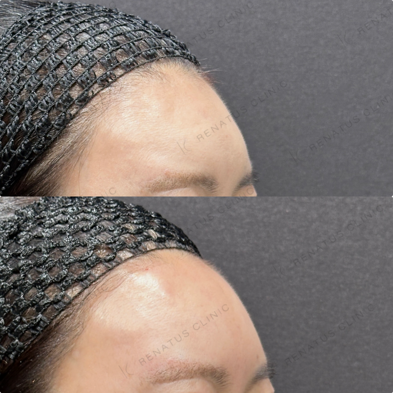 額ヒアルロン酸ボリューマ症例写真