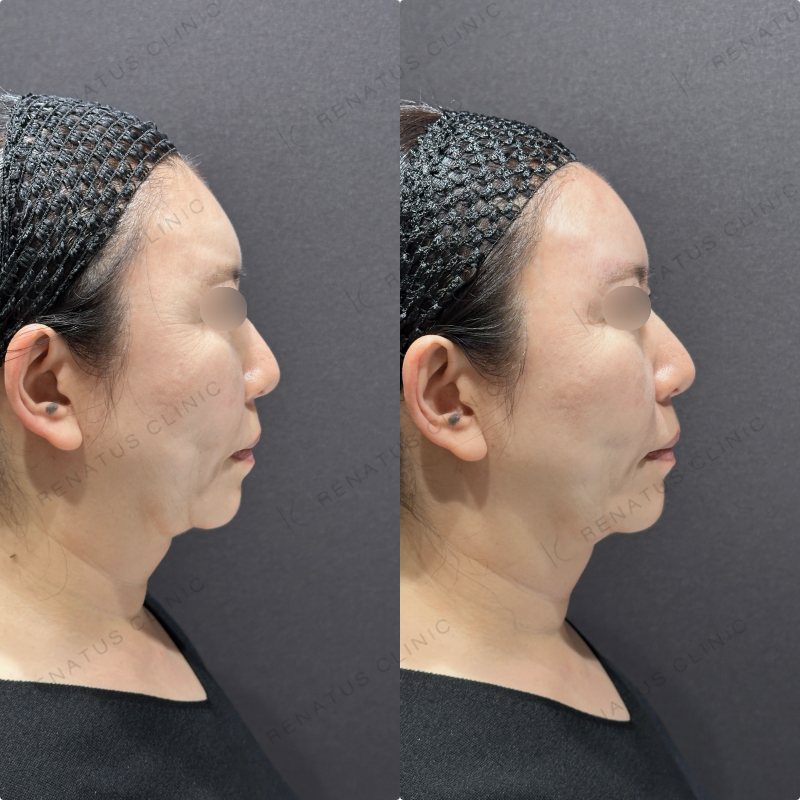 額ヒアルロン酸ボリューマ症例写真