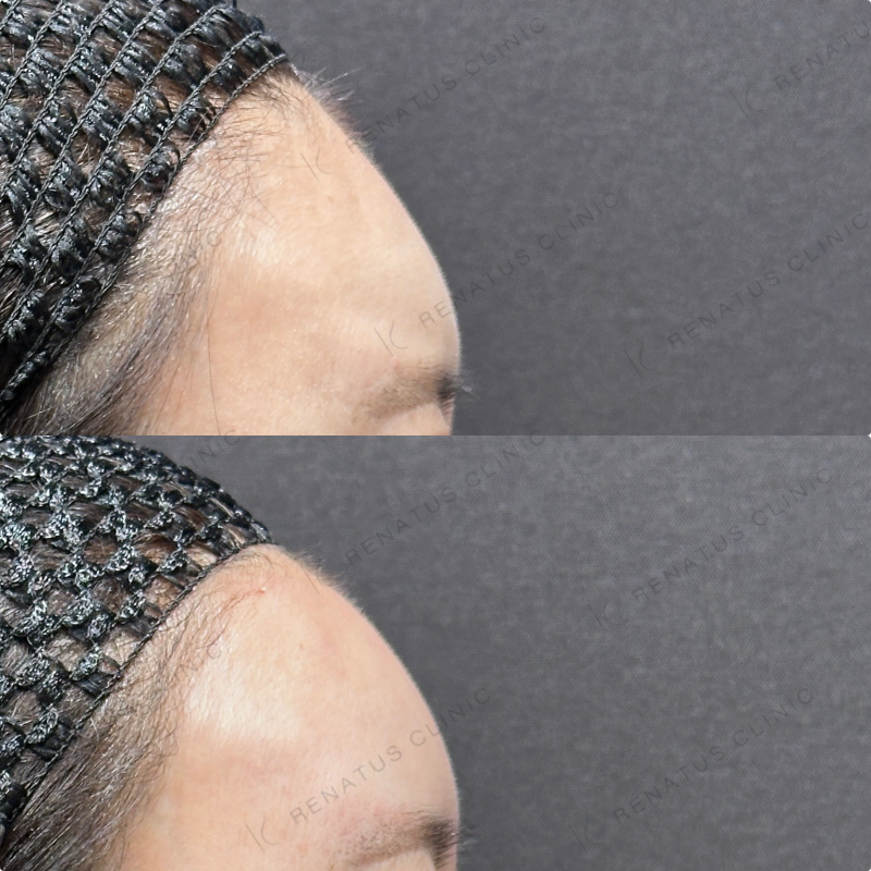 額ヒアルロン酸ボリューマ症例写真