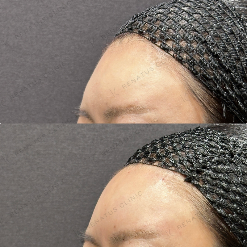 額ヒアルロン酸ボリューマ症例写真