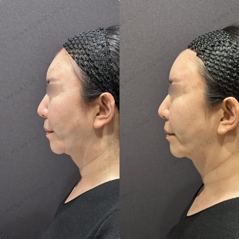 額ヒアルロン酸ボリューマ症例写真