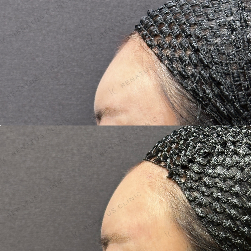 額ヒアルロン酸ボリューマ症例写真