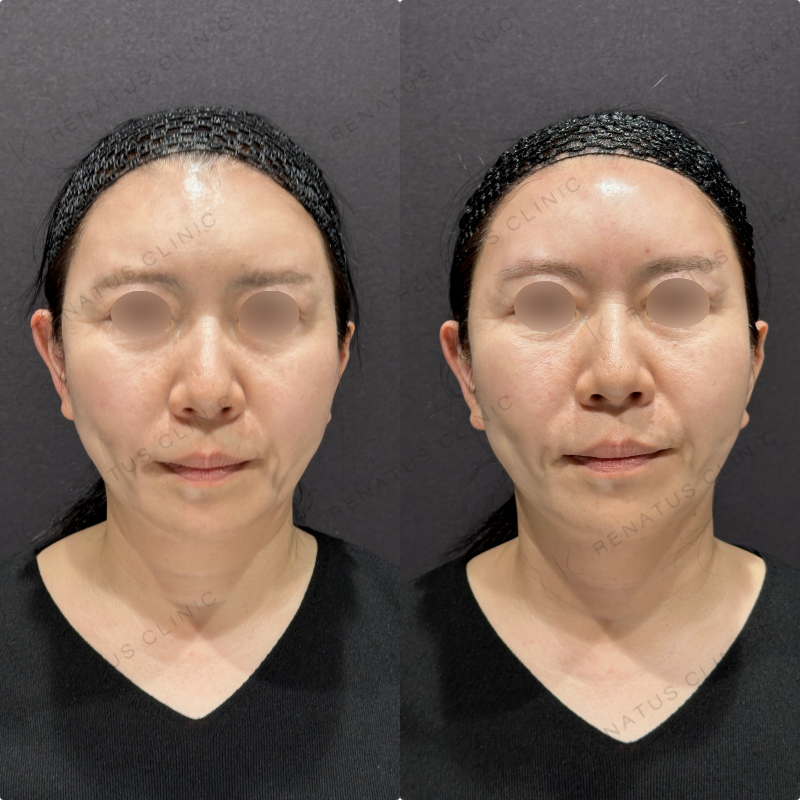 額ヒアルロン酸ボリューマ症例写真