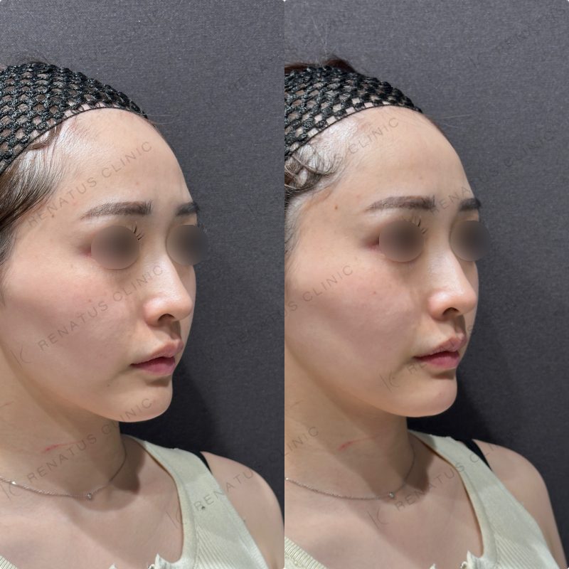 顎ヒアルロン酸ダイヤモンドフィール症例写真