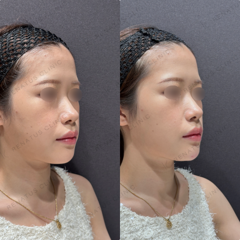 顎ヒアルロン酸ダイヤモンドフィール症例写真