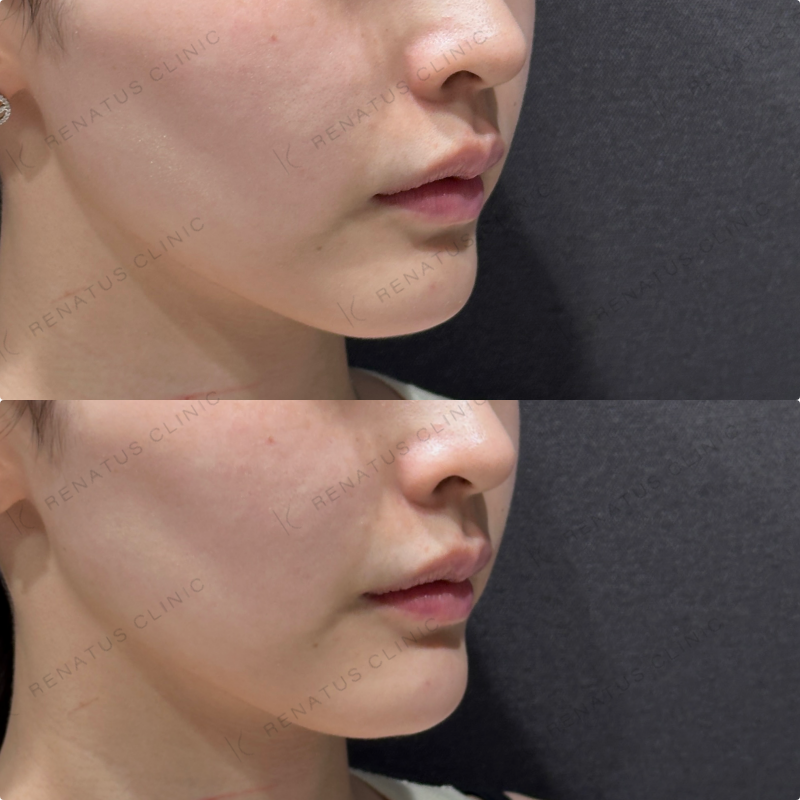 顎ヒアルロン酸ダイヤモンドフィール症例写真