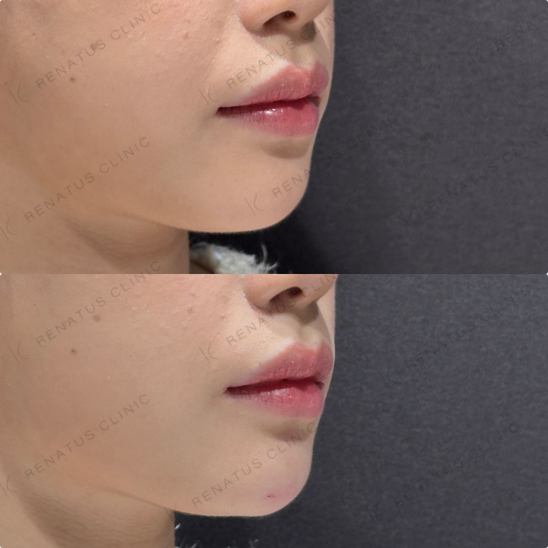 顎ヒアルロン酸ダイヤモンドフィール症例写真