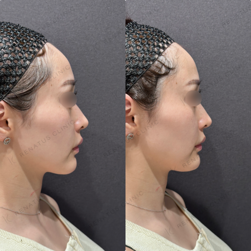 顎ヒアルロン酸ダイヤモンドフィール症例写真