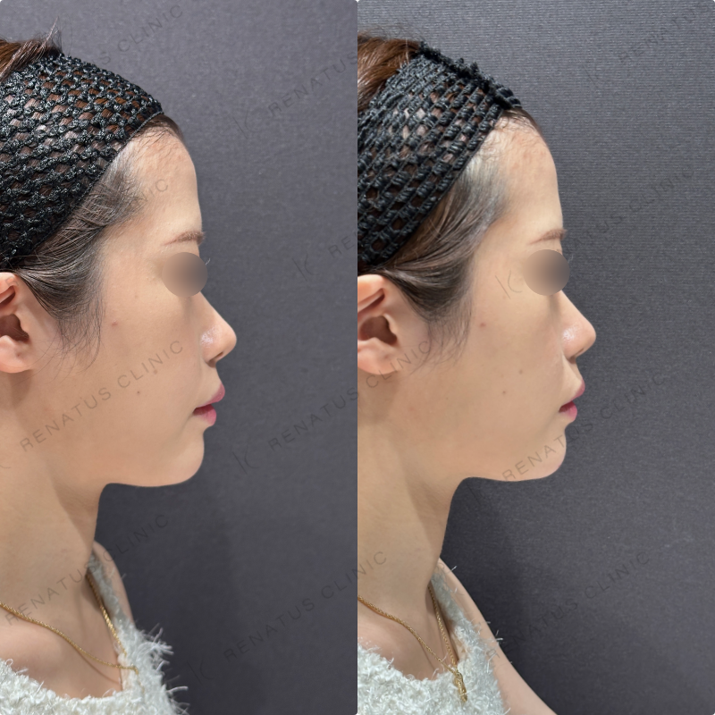 顎ヒアルロン酸ダイヤモンドフィール症例写真