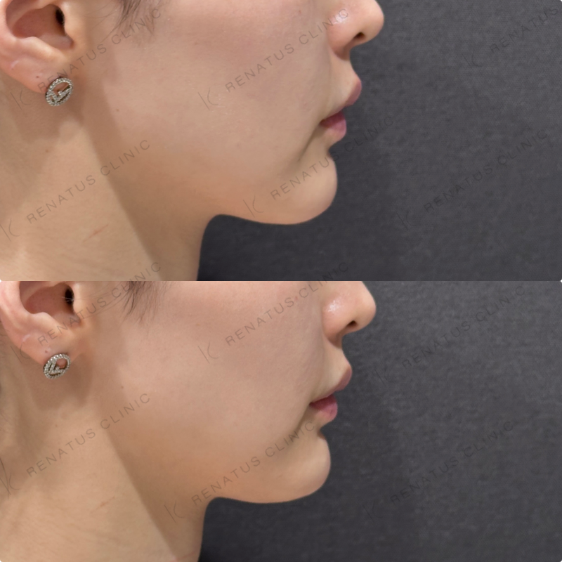 顎ヒアルロン酸ダイヤモンドフィール症例写真