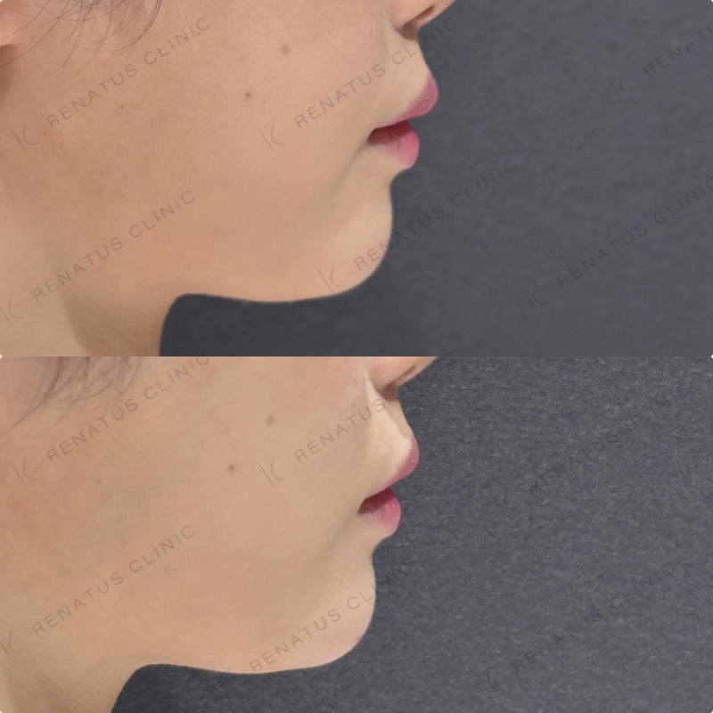 顎ヒアルロン酸ダイヤモンドフィール症例写真